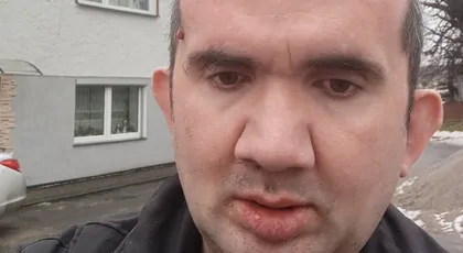 Mam  guza mózgu