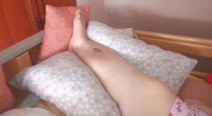 Edyta Stypa cierpiąca na słoniowatość nóg