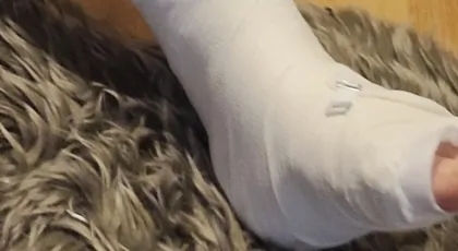 Rehabilitacja złamanej nogi