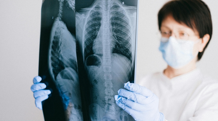 Rak płuc to nie kara za papierosy. Co warto wiedzieć o tej chorobie?